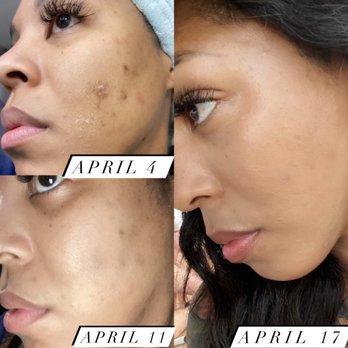 Rochelle Aesthetics - Process of chemical peel - Day Spas Near Me - Atlanta, Georgia Rochelle Aesthetics - Process of chemical peel - Day Spas Near Me - Atlanta, Georgia