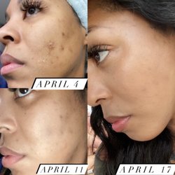 Process of chemical peel