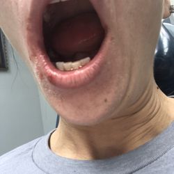 Wallace Brian D DMD - Busted lip