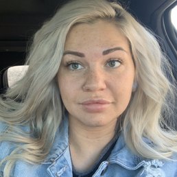 My skin after the first laser treatment