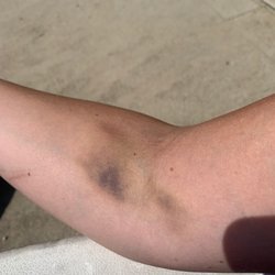 WellNow Urgent Care - Got my blood draw 6 days ago... this is the worst bruising I've ever had I regards to a simple procedure.