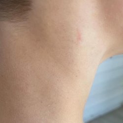 Johnson Jeffery DDS - A scratch and broken blood vessels that appeared after our dental visit.