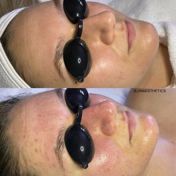 J. Luna Esthetics - Acne Program - Skin Care Near Me - Riverside, California
