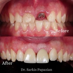 Sarkis Papazian, DDS - Dental implants #surgery