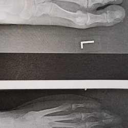 University Podiatry Group - This is my foot preop and postop - Second MPJ Cartiva (Synthetic Cartilage Implant)