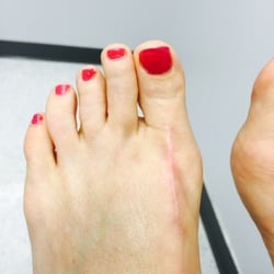 Atlanta Foot and Leg Clinic: Stanley Kalish, DPM, FACFAS - Post Operative Bunion Result