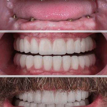 Cosmetistry by Dr P - All on x permanent dentures smile design - Cosmetic Dentists Near Me