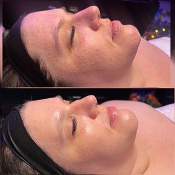 Patricia Esthetics - After 1 microchanneling facial - Skin Care Near Me - Salida, California