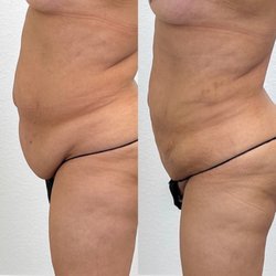 Bella Forme Medical - Fun sculpting lipo no skin tightening needed after!!