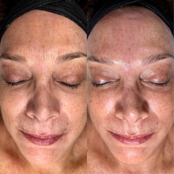 Aesthetic OOGII - Hydrafacial - Skin Care Near Me - San Francisco, California Aesthetic OOGII - Hydrafacial - Skin Care Near Me - San Francisco, California