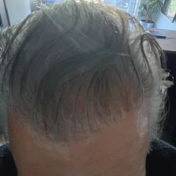 Scott Alexander, MD - Biltmore Surgical Hair Restoration