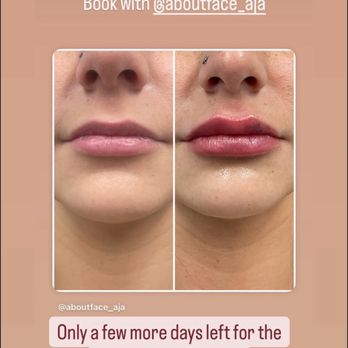 Anne Judge Aesthetics - Before and after - Medical Spas Near Me - Lafayette Hill, Pennsylvania Anne Judge Aesthetics - Before and after - Medical Spas Near Me - Lafayette Hill, Pennsylvania
