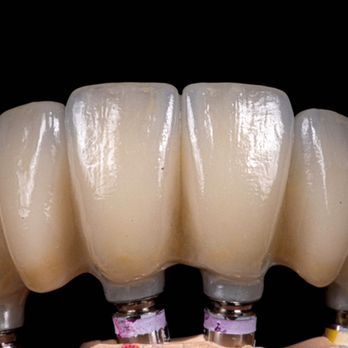 Avi Donitza, DMD - Implant Dentisrty - General Dentistry Near Me - Beverly Hills, California Avi Donitza, DMD - Implant Dentisrty - General Dentistry Near Me - Beverly Hills, California