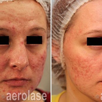 AestheticFX - Neoclear acne treatment - Medical Spas Near Me - Frisco, Texas