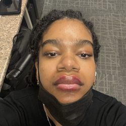 CurateMD Skin Bar and Wellness Clinic - First week after bad filler