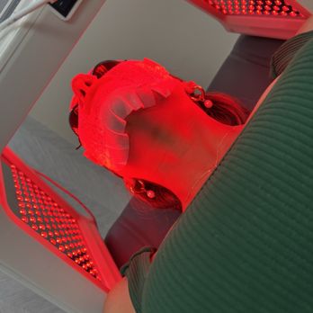 Behrooz Torkian Facial Plastic Surgery - Red light after virtue RF - Cosmetic Surgeons Near Me - Beverly Hills, California