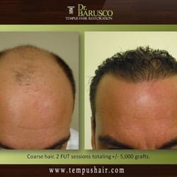 Tempus Hair Restoration - Dr. Marco Barusco actual patient great coverage.