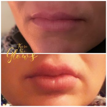 There She Glows - Hyaluron Pen (needles lip fillers) - Teeth Whitening Near Me - Pinole, California There She Glows - Hyaluron Pen (needles lip fillers) - Teeth Whitening Near Me - Pinole, California