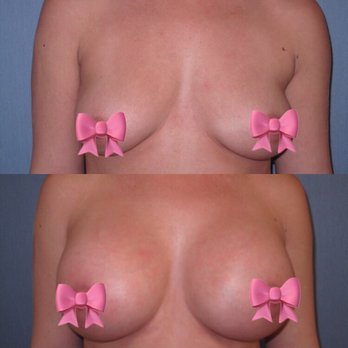 David Kim, MD - Before and after - Cosmetic Surgeons Near Me - Beverly Hills, California David Kim, MD - Before and after - Cosmetic Surgeons Near Me - Beverly Hills, California