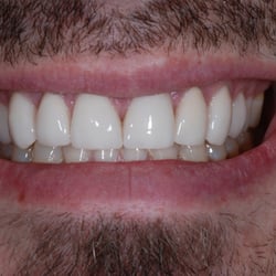 Lakeway Cosmetic Dentistry - After Cosmetic makeover -B