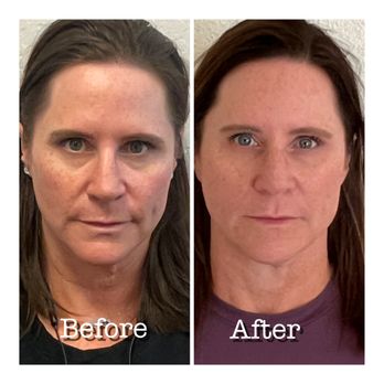 Renewed Vitality and Wellness - Juvederm Treatment - Weight Loss Centers Near Me - Reno, Nevada Renewed Vitality and Wellness - Juvederm Treatment - Weight Loss Centers Near Me - Reno, Nevada