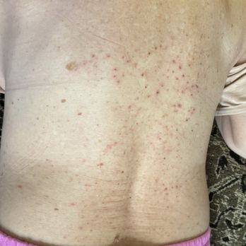 Thomas Dermatology - This was the rash. - Dermatologists Near Me - Las Vegas, Nevada Thomas Dermatology - This was the rash. - Dermatologists Near Me - Las Vegas, Nevada