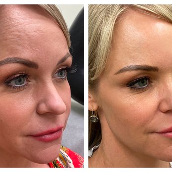 Dermatology Babcock - Natural, beautiful results! Dysport & Restylane Lip filler in Atlanta, Georgia. - Dermatologists Near Me - Atlanta, Georgia Dermatology Babcock - Natural, beautiful results! Dysport & Restylane Lip filler in Atlanta, Georgia. - Dermatologists Near Me - Atlanta, Georgia