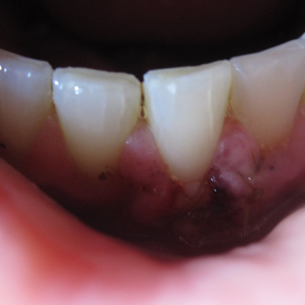Melanie D Robinson, DDS, MS - Right after gum grafting surgery. Mmmmm zombie necrotic gum.. - Periodontists Near Me - Austin, Texas Melanie D Robinson, DDS, MS - Right after gum grafting surgery. Mmmmm zombie necrotic gum.. - Periodontists Near Me - Austin, Texas