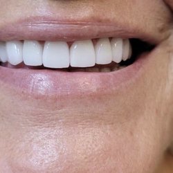 Crossroads Dental Group - Smile makeover done with minimal preparation of teeth. Teeth restored with emax , highly esthetic crowns and venners.
