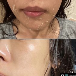 Facecard Medspa - VI PEEL PROCESS AND AFTER