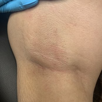 Polished Esthetics - After an under arm wax - Waxing Near Me Polished Esthetics - After an under arm wax - Waxing Near Me
