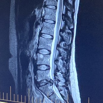 Tulsa Spine and Rehab Chiropractic - Spinal cord pinched by bone fragment. - Chiropractors Near Me - Tulsa, Oklahoma Tulsa Spine and Rehab Chiropractic - Spinal cord pinched by bone fragment. - Chiropractors Near Me - Tulsa, Oklahoma