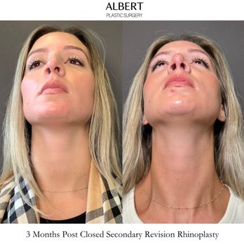 Mark G Albert, MD - Closed (Scarless) Secondary Revision Rhinoplasty - Cosmetic Surgeons Near Me - New York, New York