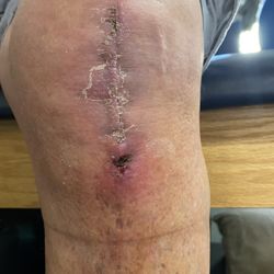 Low Country Physical Therapy - Early pic. Now I'm in good shape after 12 weeks.