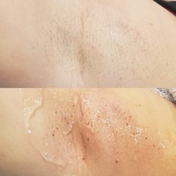 Bare Body Bar - Laser hair removal