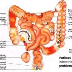 Healing Haven 360 - What an unhealthy colon can look like.