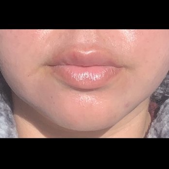 Vitality Aesthetics - After Lip Filler - Medical Spas Near Me - San Diego, California Vitality Aesthetics - After Lip Filler - Medical Spas Near Me - San Diego, California