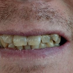 Diamond Lake Dental - Teeth before the crowns