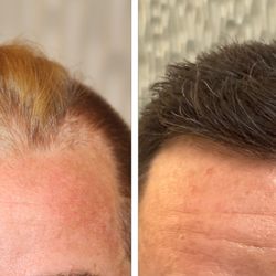 Modena Hair Institute - Patient underwent an FUE DHI Hair Transplant by DR. Yazdan in Las Vegas