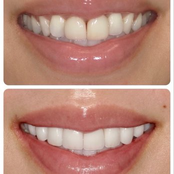 Smiles by Design Dentistry - Top is before, bottom is after top 8 veneers - Cosmetic Dentists Near Me - Los Gatos, California Smiles by Design Dentistry - Top is before, bottom is after top 8 veneers - Cosmetic Dentists Near Me - Los Gatos, California