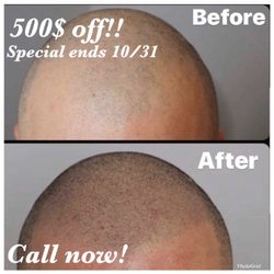 Scalp Excellence - 500$ off a procedure 1500$ or more. Only for the month of October!