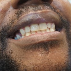 USmile Dental - After