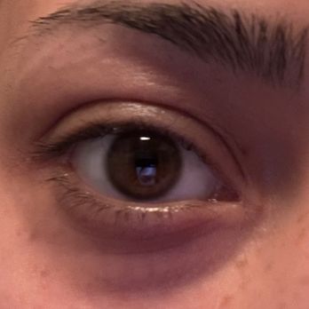 Trendy Salon & Spa - My eyes don't have double lids, this is the amount of swelling. - Hair Salons Near Me - Fullerton, California Trendy Salon & Spa - My eyes don't have double lids, this is the amount of swelling. - Hair Salons Near Me - Fullerton, California