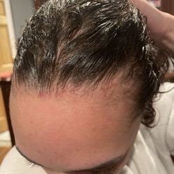 Sophie African Hair Braiding - My scalp clearly red, raised (nearly bleeding) from the tension of the braids. (Obvious hair thinning)