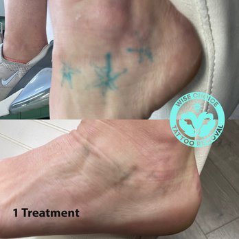 Wise Choice Tattoo Removal - Homemade tattoo is no match for the PicoSure laser. Book today - Tattoo Removal Near Me - Denver, Colorado Wise Choice Tattoo Removal - Homemade tattoo is no match for the PicoSure laser. Book today - Tattoo Removal Near Me - Denver, Colorado