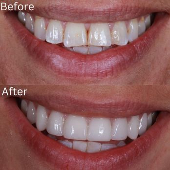 Joseph Goodman, DDS, DMD - My before photo up top which I would never show in the past and my after on the bottom! - General Dentistry Near Me - Beverly Hills, California Joseph Goodman, DDS, DMD - My before photo up top which I would never show in the past and my after on the bottom! - General Dentistry Near Me - Beverly Hills, California