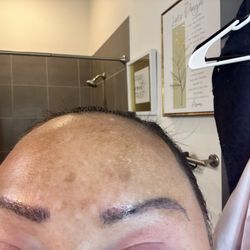 Athena Beauty Bar - 10 days later with infection