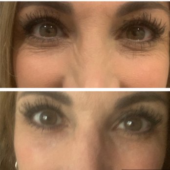 Advanced SkinCare - Before and after tear trough filler - Medical Spas Near Me - Fullerton, California