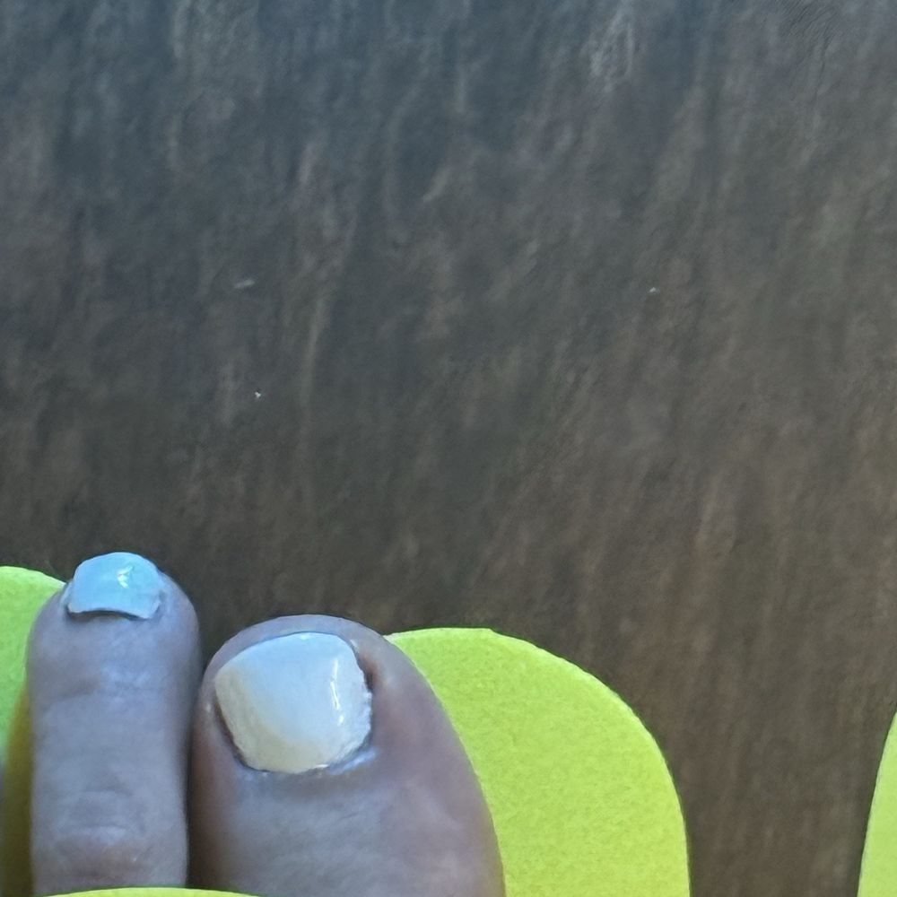 Bleeding toenail