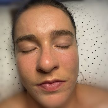Skinterest Regenerative Esthetics - After just my first treatment! - Skin Care Near Me - Laguna Niguel, California